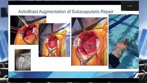 The Foundation of Collagen Co-Braid: From Development to Early Clinical Use