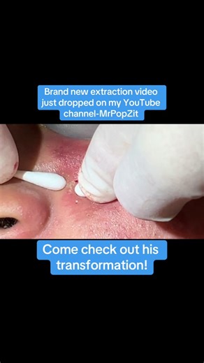 Come see his entire extraction video that just dropped on my YouTube channel-MrPopZit. #medicaleducation #dermatology #skincare #mrpopzit #mrpopzitlive #youtube #youtuber #physicianassociate #skin #popaholic #extractions #acne #acneskin #acnetreatment