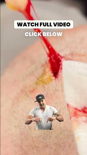 SCALP CYST!