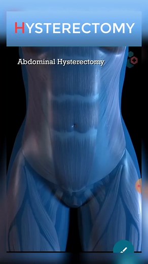 Abdominal Hysterectomy Procedure Short view #surgery #body #people #awareness #heartdisease #medicalanimationmedical