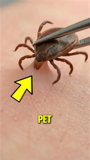 What Happens When You Rip a Tick Out Too Quickly?