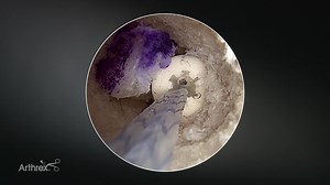 Independent FiberTape® Suture Routing for ACL Reconstruction Using the InternalBrace™ Technique