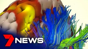 72K views · 35 reactions | There’s hope new findings on what part of the brain causes ADHD could lead to more effective treatments for people with the disorder. Queensland researchers used advanced modelling to compare the brains of people with ADHD and those without. “Put another way, if you have two people talking but one person has some noise that disturbs his message to the other person” – Dr Luca Cocchi. More: 7news.link/LfSoIf #7NEWS | 7NEWS Brisbane | Facebook