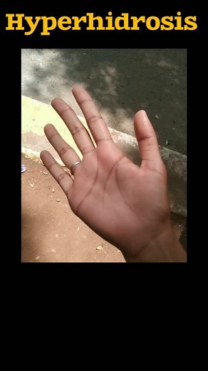Dr. Harini PT🌸⚕️ on Instagram: "Types: 1. Focal Hyperhidrosis: Excessive sweating in specific areas (e.g., underarms, palms, soles, face). 2. Generalized Hyperhidrosis: Widespread excessive sweating. 3. Axillary Hyperhidrosis: Excessive underarm sweating. 4. Palmar Hyperhidrosis: Excessive palm sweating. 5. Plantar Hyperhidrosis: Excessive sole sweating. Causes: Anxiety or stress Medical conditions (e.g., diabetes, thyroid disorders, menopause) Medications (e.g., antidepressants, blood pressure