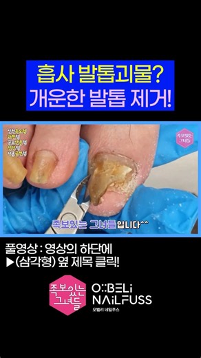 흡사 발톱괴물? 개운한 발톱 제거! 😫 #내성발톱 #toenails #ingrown_toenail #발톱무좀 #무좀 #무좀발톱 #족보있는그녀들