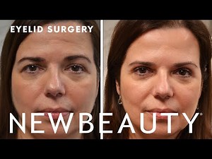 Inside an Eyelid Surgery (Upper Blepharoplasty) | Underneath the Surface | NewBeauty