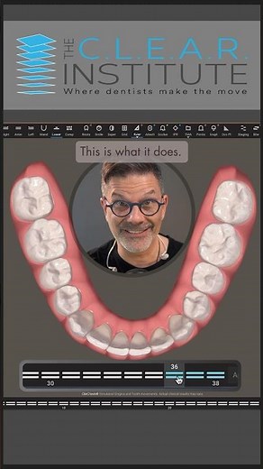 What are invisalign aligners overcorrection trays? #invisalign #dentist