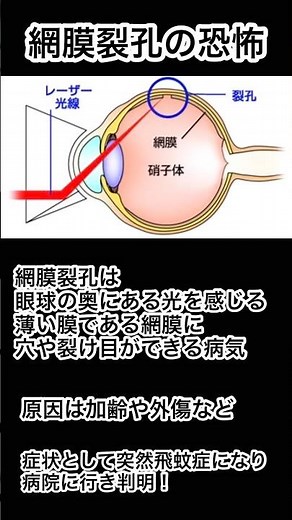 網膜剥離の恐怖！網膜裂孔はすぐ治療！飛蚊症が突然出たらすぐ眼科へ！現在2回レーザー治療 網膜剥離を回避したい！#治療 #眼科 #病気 #shorts