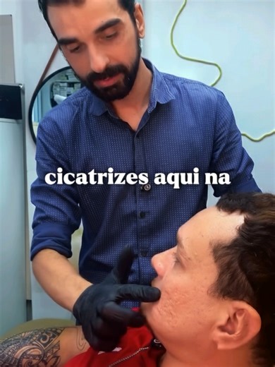 Tratamento de Cicatrizes de Acne com Dr. Leandro Bessa