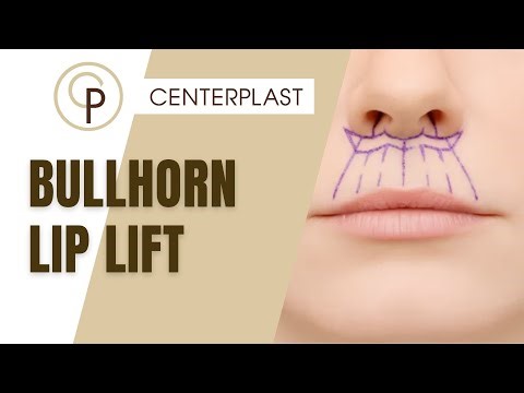 Bullhorn Lip Lift – die DAUERHAFTE Lösung für schmale Lippen