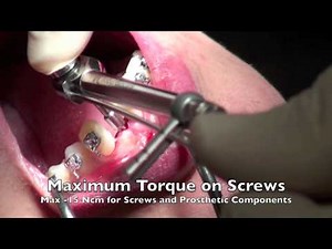 Dental Implant Surgery NobelActive 3.0 mm