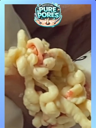 Extreme Blackhead Removal and Deep Pore Cleansing ASMR