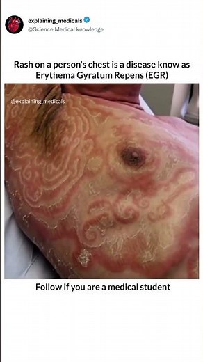 Rash on a person's chest is a disease know asErythema Gyratum Repens (EGR).