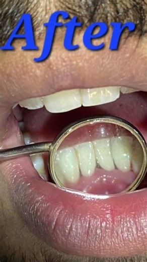 Teeth scaling removing and tartar and calculus from teeth surfaces preventing gum disease and #short