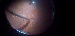 Minimally Invasive Vitrectomy for Phakic Retinal Detachment - Eyetube