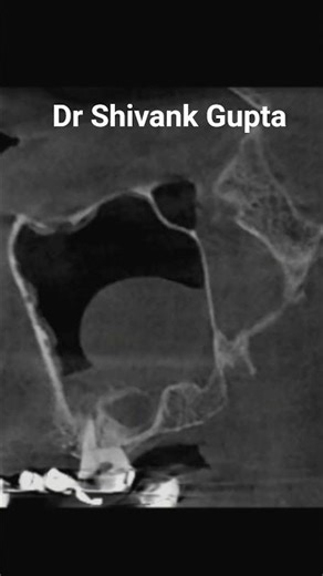 👉 This Growth in Your Sinus Can Go Unnoticed 😳 | Maxillary Sinus Polyp #cbct #radiology #pathology