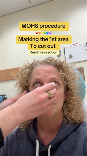 MOHS procedure for skin cancer #basalcellcarcinoma #skincancerawareness #skincancer #mohs