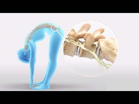 "Why prodisc® L?" Patient Explainer for Total Disc Replacement | Lumbar Spine Disc Arthroplasty