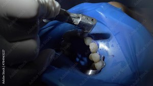 Polishing teeth with a polisher. The final step after the mechanical removal of tartar deposits and coatings