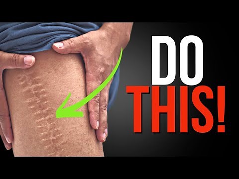 How to Massage Your Scar After Knee Replacement
