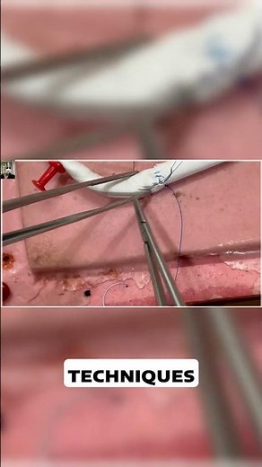 5.10 Switching Techniques for Improved Vascular Surgery #drstrangemch #cardiovascularsurgery