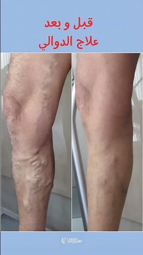 Avant est après traitement des varices par laser endoveineux et sclérothérapie