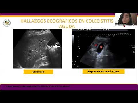 Colecistitis aguda en ecografía