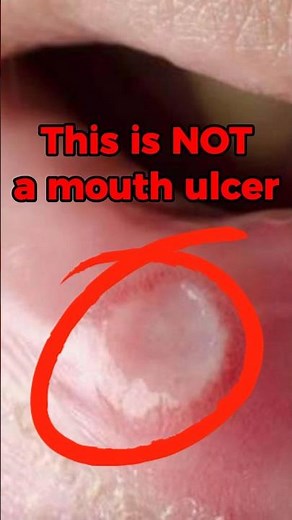 Understanding Syphilis and Its Symptoms #syphilis #shorts