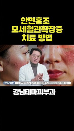 홍조증 모세혈관확장증 치료 방법 #안면홍조#모세혈관확장증