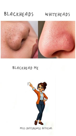 Blackheads vs Whiteheads: What’s the Difference?