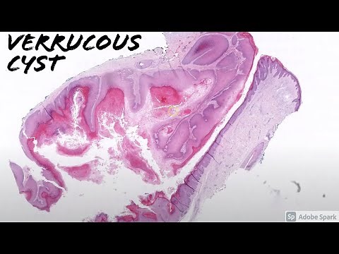 Verrucous Cyst: 5-Minute Pathology Pearls