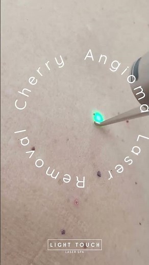 Erase Cherry Angiomas with Expert Laser Care! Light Touch Laser Spa #cherryangiomas #skincare