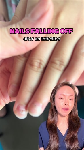 Are your nails falling off after an infection? 😩 #handfoodandmouthdisease #nails #nailshedding #derm #dermdoctor