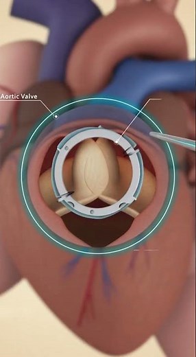 Inside Heart Surgery | How Life is Saved