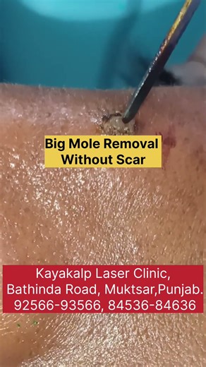 Big Mole Removal Without Scar | Laser & RF Scarless Results