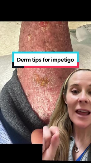 Understanding Impetigo: Causes, Symptoms, and Treatment Options