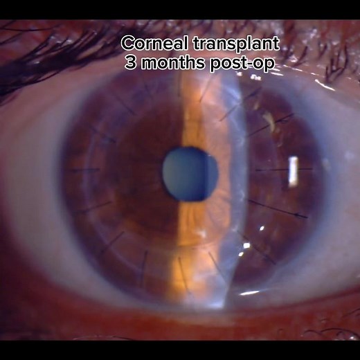 Corneal transplant