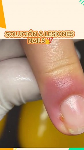 👉 SOLUCIÓN A LESIONES NAILS💅💅🎉 . . . #fbreelsfypシ゚viralシ #fypシ #tutorialescreativos #nailinspo2024 #uñasacrilicasdecoradas #uñasbonitas #uñasdemoda #uñasdepies #uñaschallenge #uñasacrilicas #fall2024 #fashion #seguidoresdefacebook | Arte en tus manos
