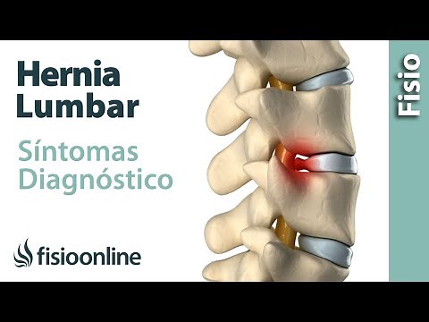 How to know if you have a lumbar disc herniation - Symptoms and diagnosis of a herniated disc