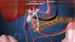 医学科普短片：ERCP演示及其适应证