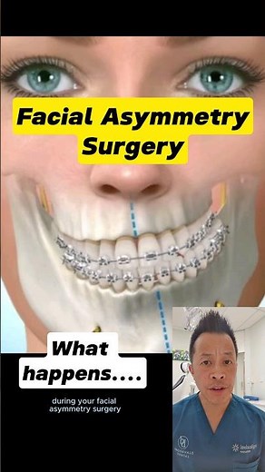 Facial Asymmetry Surgery: What to Expect #dentallan #shorts #dentist