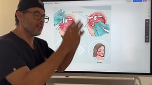 Buccal Fat Pad Removal Part Two
