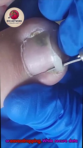 Daily Nail Care Habits for Overgrown Toenails With Lasting Results 🍉🍓 #SafeSteps #HealthyHabits #DiabeticFootCare | Bye