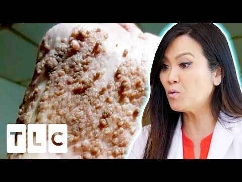 "I've Never Seen Quite An Extensive Case As This!" | Dr. Pimple Popper: Before The Pop