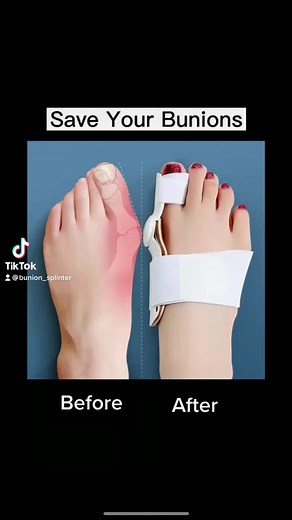 She wasn’t even following us 🤦🏽‍♂️ #bunionsplinter #tiktokmademebuyit #halluxvalgus #toecrack #painrelief