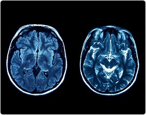 What is Joubert Syndrome?