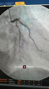 156 reactions · 35 shares | AWMI, qRBB, with cardiogenic shock, TVD, primary angioplasty within 15 minutes of arrival, discharged him on day 5 | Practical Interventional Cardiology | Facebook