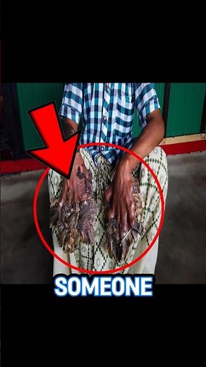 The real "Treeman" Condition