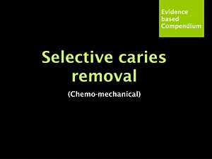 Selective caries removal (Chemo-mechanical) - SlideServe