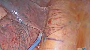 Multifocal lung cancer discussion and case presentation - Mayo Clinic